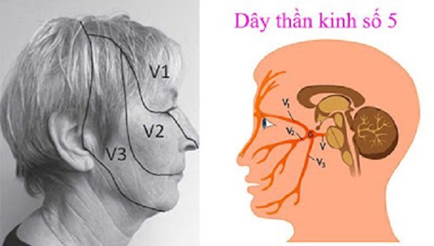 viêm dây thần kinh số 5 ở mặt