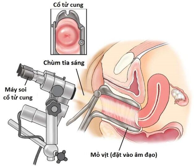 Một trong những biện pháp để khám sàng lọc ung thư cổ tử cung