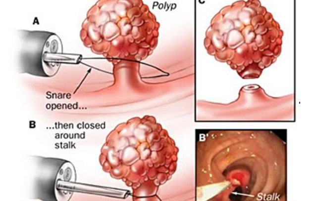 cách phẫu thuật polyp đại tràng