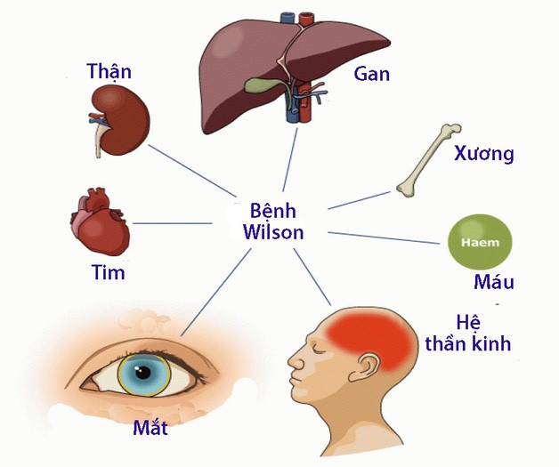 Tác động đến các cơ quan của bệnh Wilson