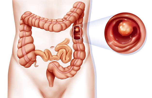 cách polyp đại trực tràng hình thành 