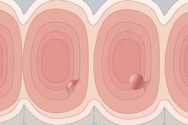 polyp đại trực tràng lớn có nguy cơ gây ung thư