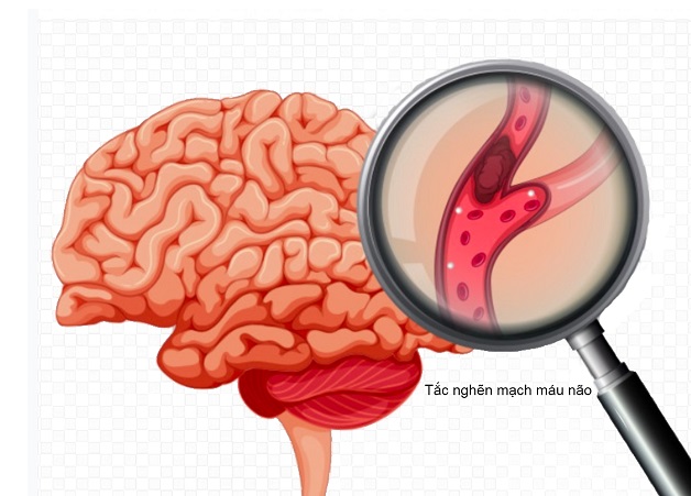Rối loạn giấc ngủ kéo dài có thể gây đột quỵ
