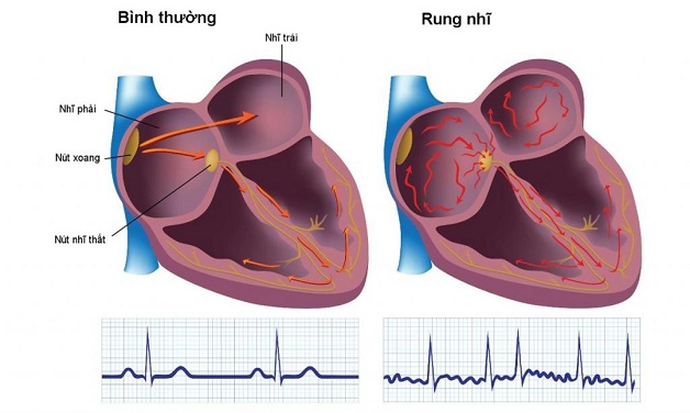 Rung nhĩ là dạng rối loạn nhịp nhanh dễ dẫn đến đột tử