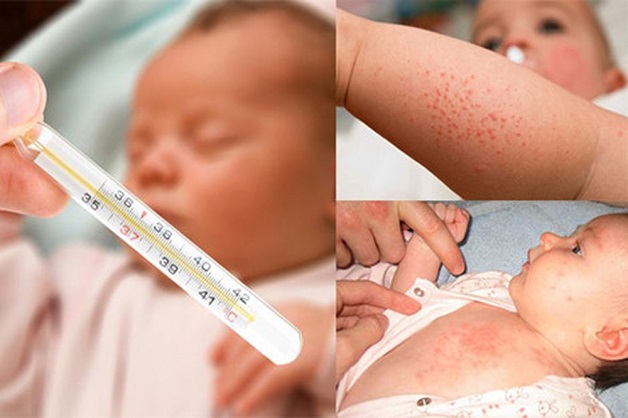 hãy luôn đo nhiệt độ, bù nước và khoáng cho trẻ hợp lý khi trẻ bị sốt phát ban