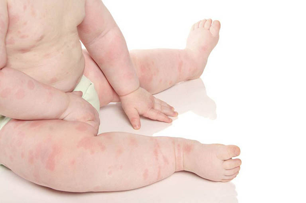 những nốt mẩn ngứa do côn trùng cắn có thể tăng nguy cơ trẻ bị sốt phát ban