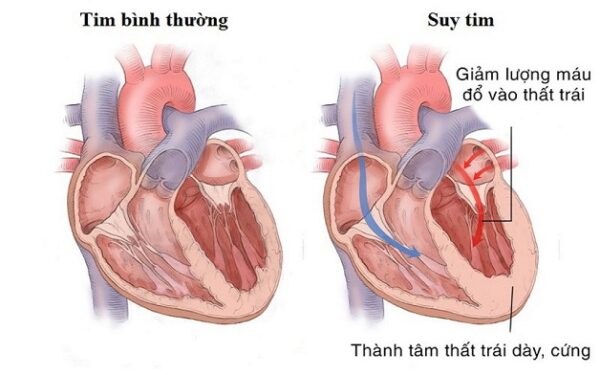 Suy tim sẽ khiến lượng máu qua tim đi nuôi cơ thể bị suy giảm