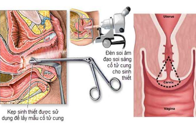 các xét nghiệm sàng lọc cổ tử cung