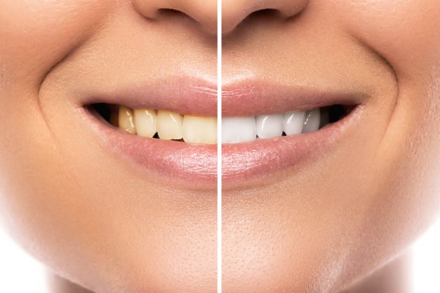 Hiệu quả của tẩy trắng răng