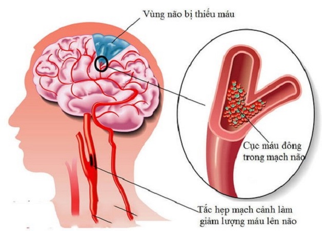 thiếu máu não thoáng qua TIA thường hồi phục trước 24 giờ.