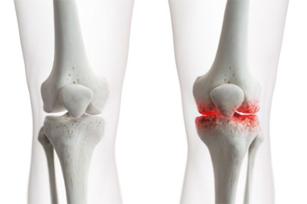 Thoái hóa khớp gối ở người già xảy ra khi xương khớp bắt đầu lão hóa