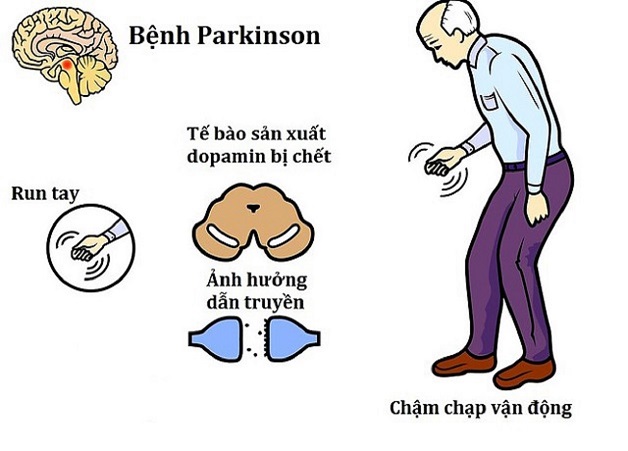 bệnh parkinson là gì