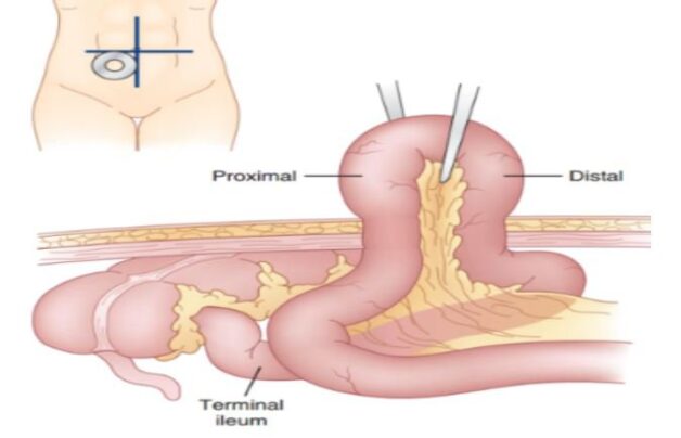 Phẫu thuật viêm đại tràng ảnh hưởng đến chức năng ruột nên chỉ được thực hiện trong trường hợp thật cần thiết.