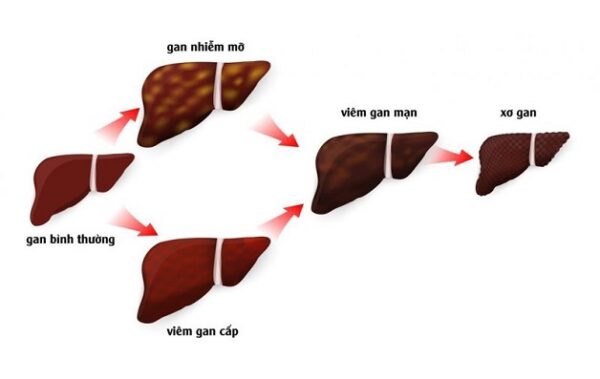 Triệu chứng xơ gan thường ở giai đoạn đầu mờ nhạt, khó nhận biết