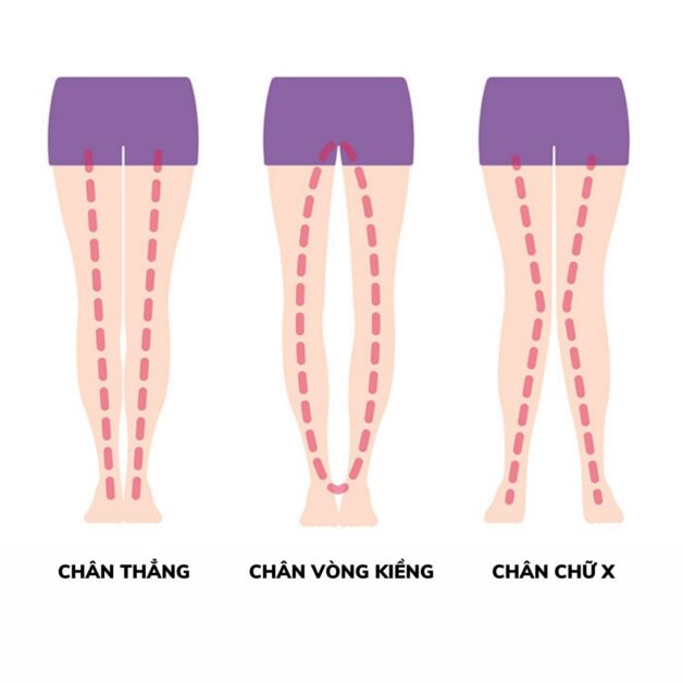 Còi xương làm trẻ bị chân vòng kiềng