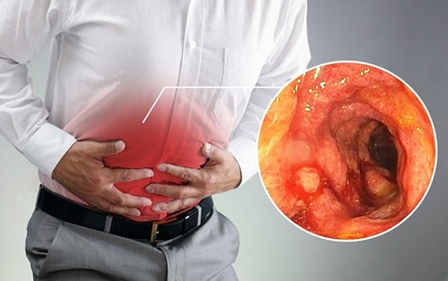 Biến chứng của viêm đại tràng là xuất huyết tiêu hóa