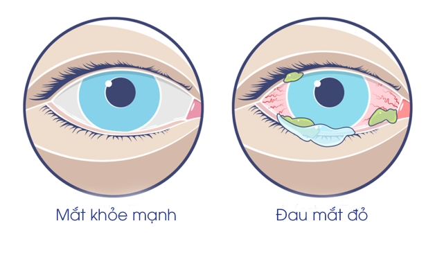 viêm kết mạc cấp là như thế nào