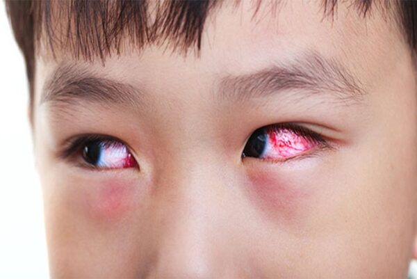 Viêm kết mạc có nguy hiểm không và biến chứng là gì, hãy cùng tìm hiểu