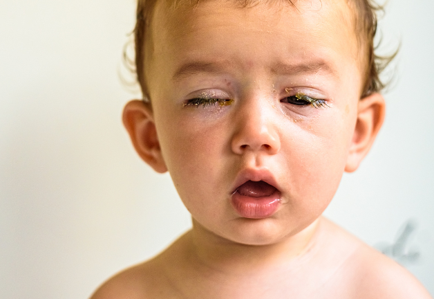 Ai cũng có thể bị viêm kết mạc, kể cả trẻ sơ sinh và trẻ nhỏ