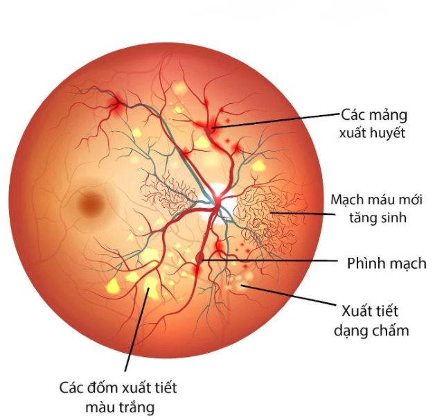 viêm kết mạc xuất huyết bao lâu khỏi