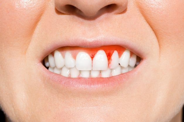 Dấu hiệu bệnh viêm lợi loét hoại tử cấp. 
