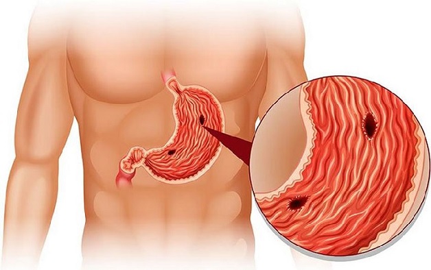 nguyên nhân viêm ruột cấp là gì