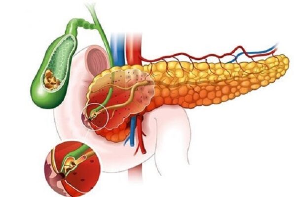 Nguyên nhân viêm tụy cấp thường gặp là do rượu bia, thuốc lá, sỏi