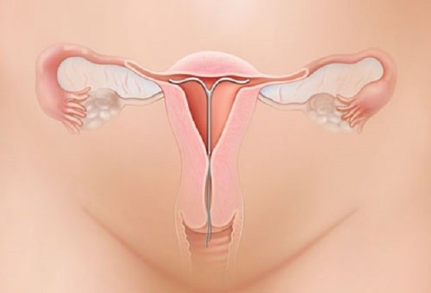 vòng tránh thai iud
