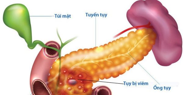 Xét nghiệm men tụy tăng cao cảnh báo viêm tụy cấp