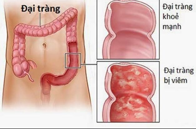 Hiểu rõ về bệnh để chăm sóc bệnh nhân bị viêm đại tràng