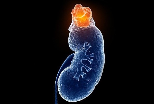 Bệnh suy tuyến thượng thận là bệnh lý không thể chữa khỏi hoàn toàn