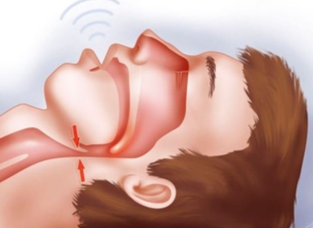 dấu hiệu của bệnh đột quỵ tim - gián đoạn nhịp thở