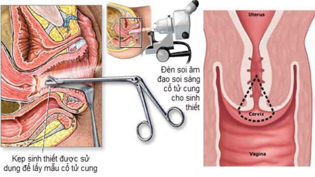 các phương pháp bổ sung để tầm soát ung thư cổ tử cung