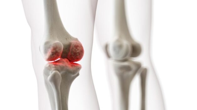 Thoái hóa sụn khớp gối, khớp háng, khớp cổ tay là những vị trí dễ bị thoái hóa