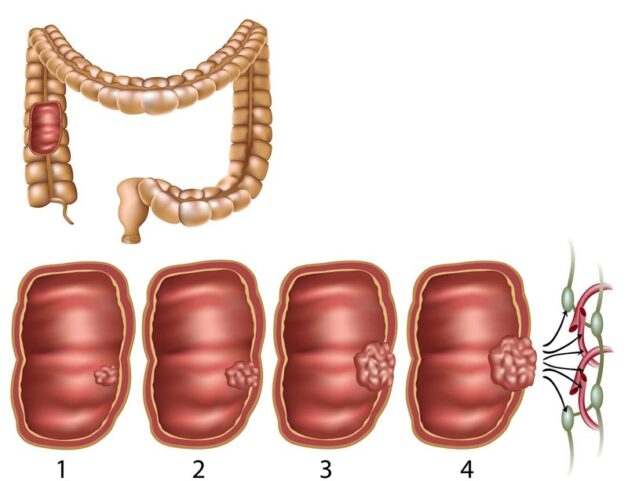 Biểu hiện ung thư đại tràng và cách phòng tránh