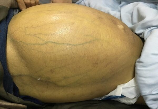Bệnh xơ gan cổ trướng có lây không?