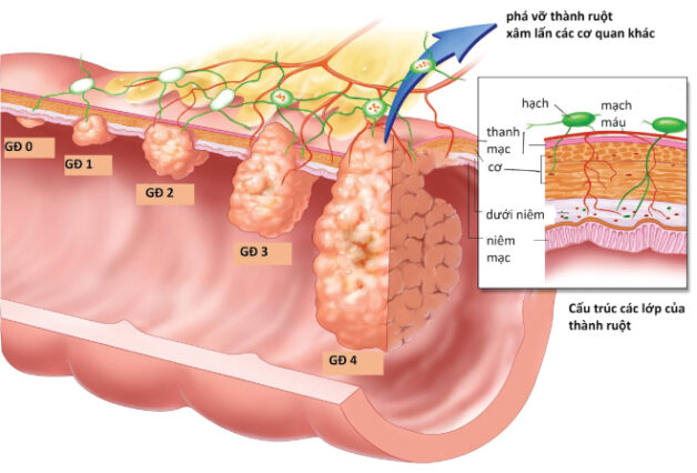 Điều trị bệnh ung thư đại tràng các giai đoạn