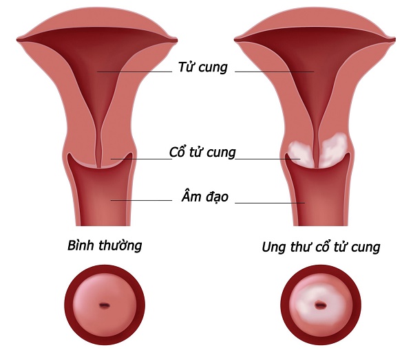 bệnh ung thư cổ tử cung là gì