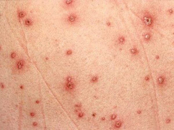 cách nhận biết bệnh thủy đậu