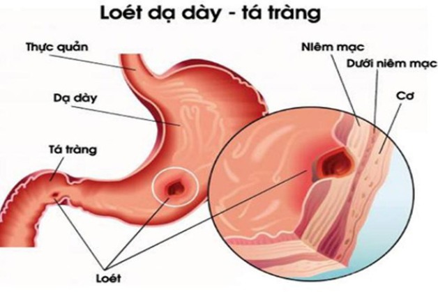 nội soi dạ dày không đau