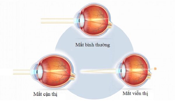 Khai niệm cận thị và viễn thị