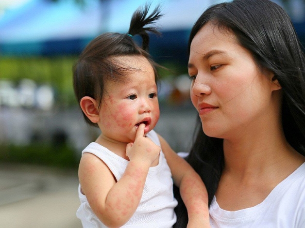 chăm sóc trẻ bị tay chân miệng