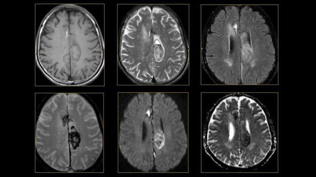 Chụp MRI não giúp bác sĩ phát hiện và chẩn đoán một số bệnh lý