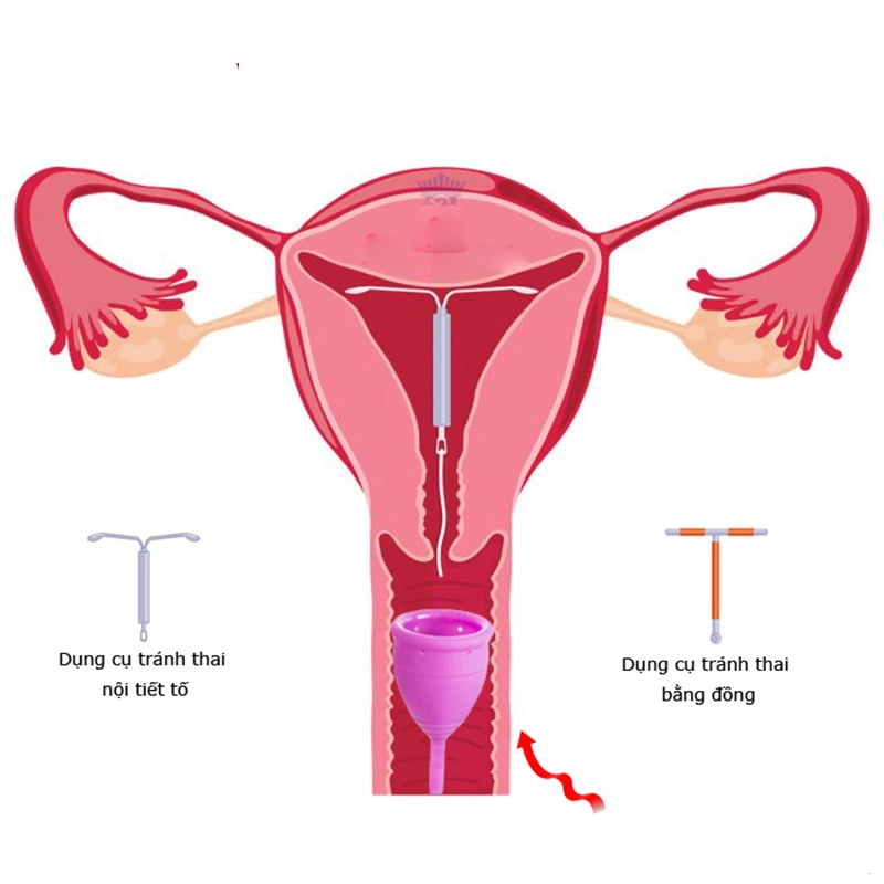Đặt vòng có nên dùng cốc nguyệt san là câu hỏi được nhiều chị em quan tâm.
