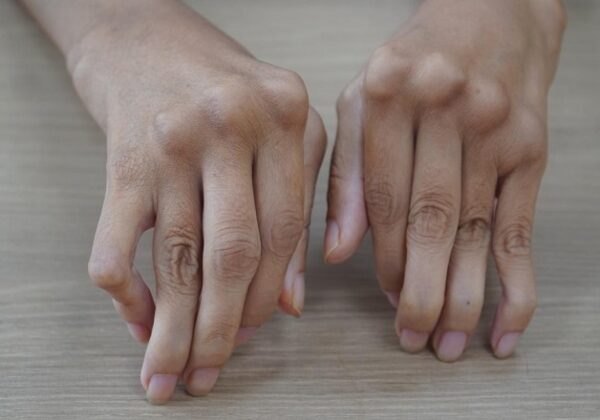 Khi có dấu hiệu viêm khớp dạng thấp chúng ta nên làm gì?