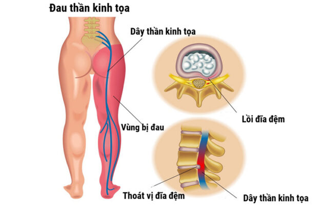 Đau thần kinh tọa ảnh hưởng nhiều đến vận động, đi lại, sinh hoạt hàng ngày của bệnh nhân