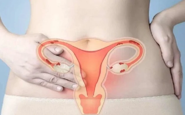 Ung thư buồng trứng diễn biến ở giai đoạn 3 và cách điều trị