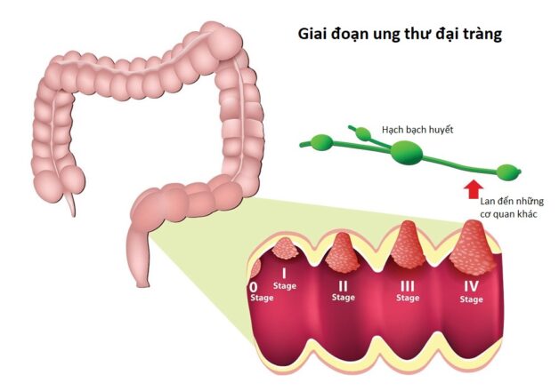 Tìm hiểu về bệnh ung thư đại tràng ở giai đoạn đầu