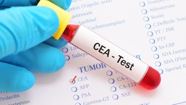 Giá trị của CEA trong tầm soát ung thư đại tràng