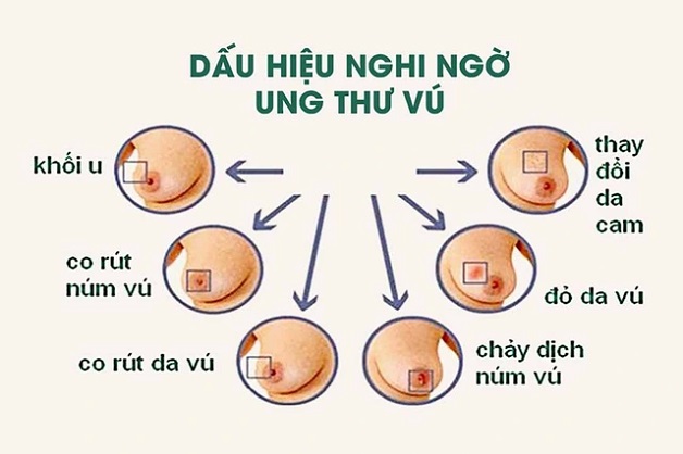 dấu hiệu ung thư vú
